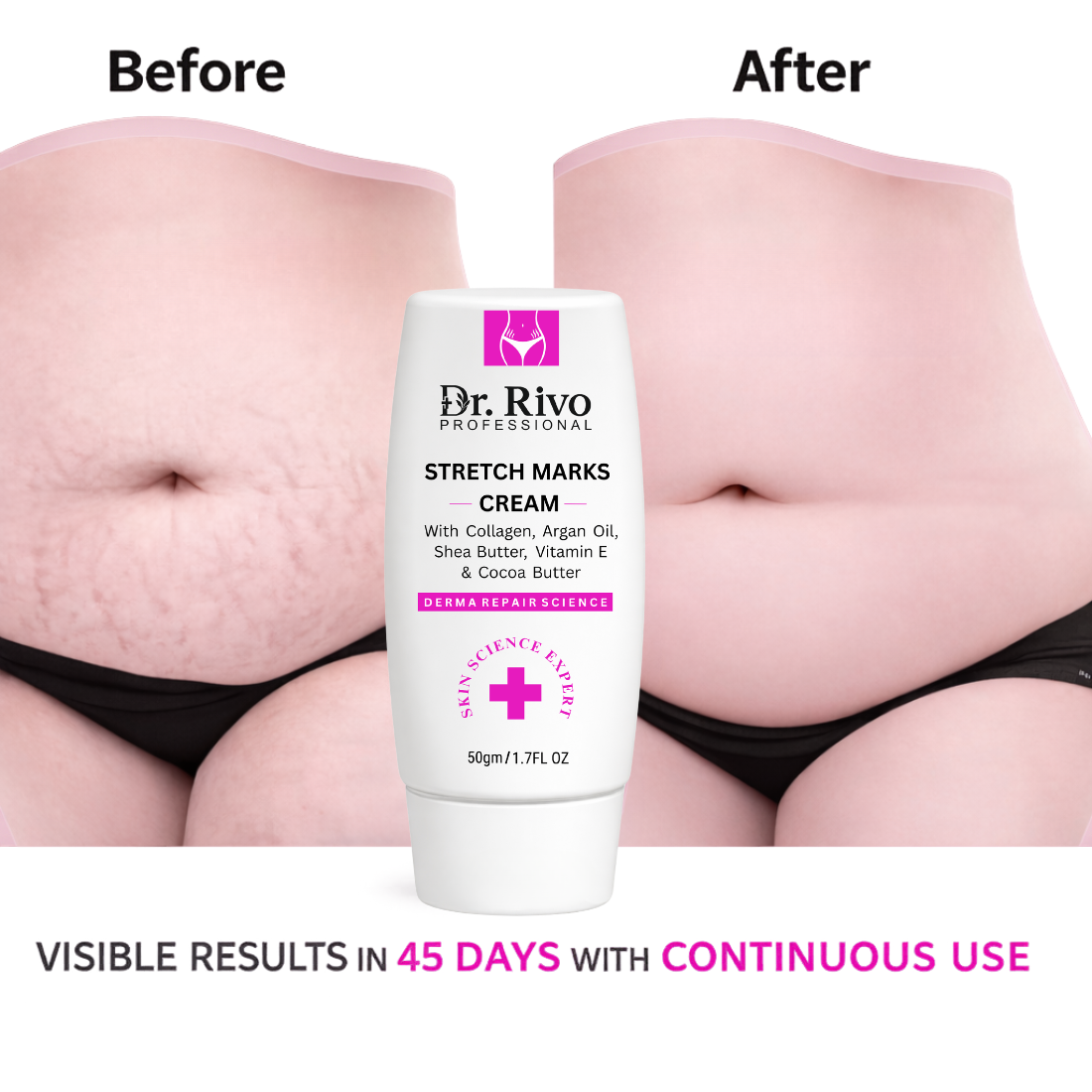 Stretch Marks Cream