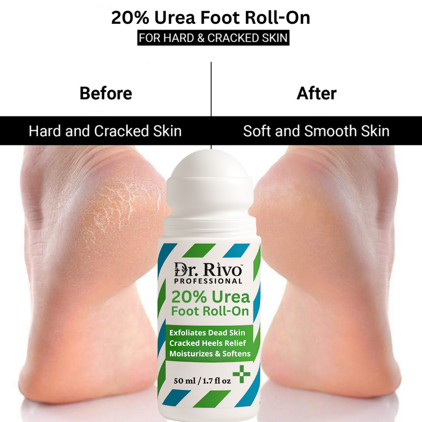 20% Urea Foot Roll-On | For Dry & Cracked Heels (50 ml, Set of 1)