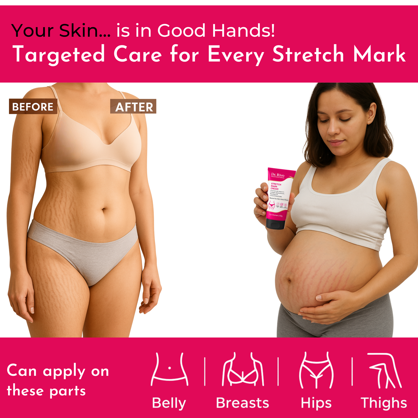 Stretch Marks Removal Cream in During After Pregnancy Delivery  (50 g)