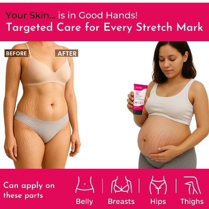 Stretch Marks Removal Cream in During After Pregnancy Delivery  (50 g)