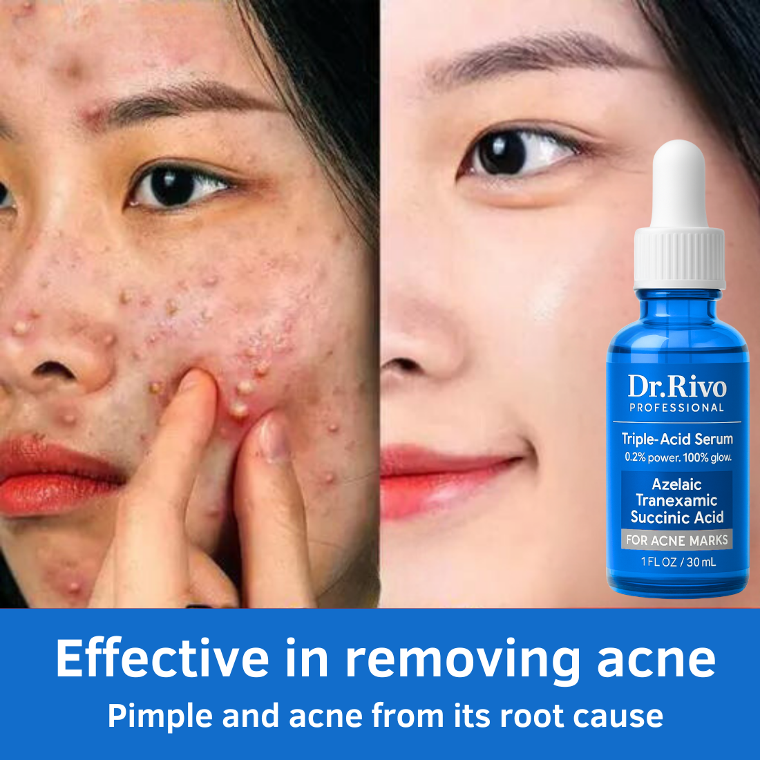 Triple-Acid Face Serum – Fades acne marks, brightens skin & boosts glow. 0.2% active formula. Gentle, effective & fast-absorbing.