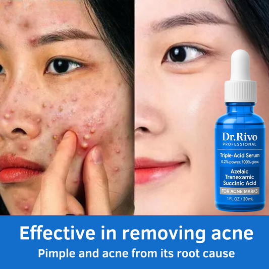 Triple-Acid Face Serum – Fades acne marks, brightens skin & boosts glow. 0.2% active formula. Gentle, effective & fast-absorbing.
