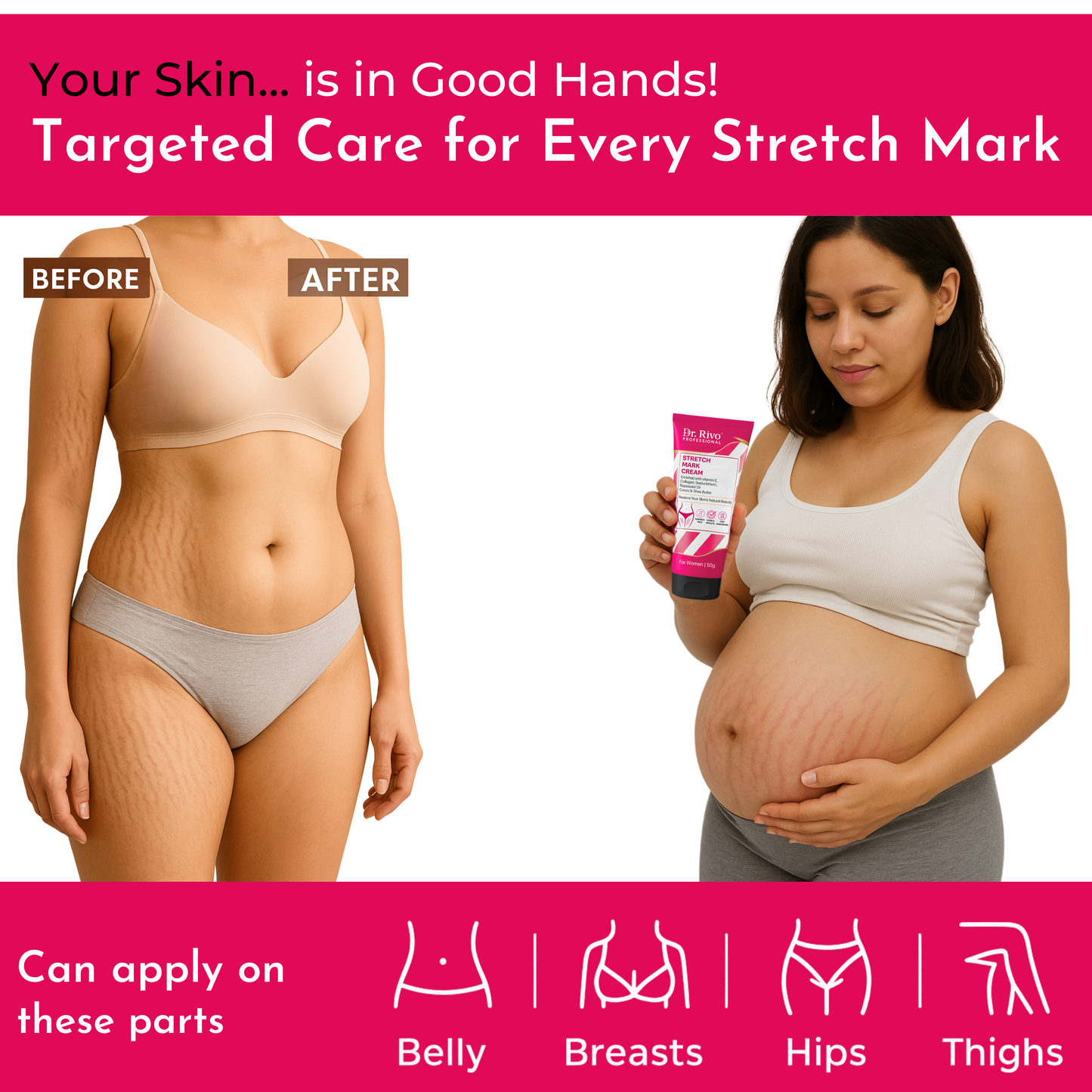 Stretch Marks Removal Cream in During After Pregnancy Delivery  (50 g)
