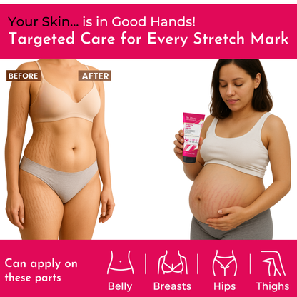 Stretch Marks Removal Cream in During After Pregnancy Delivery  (50 g)