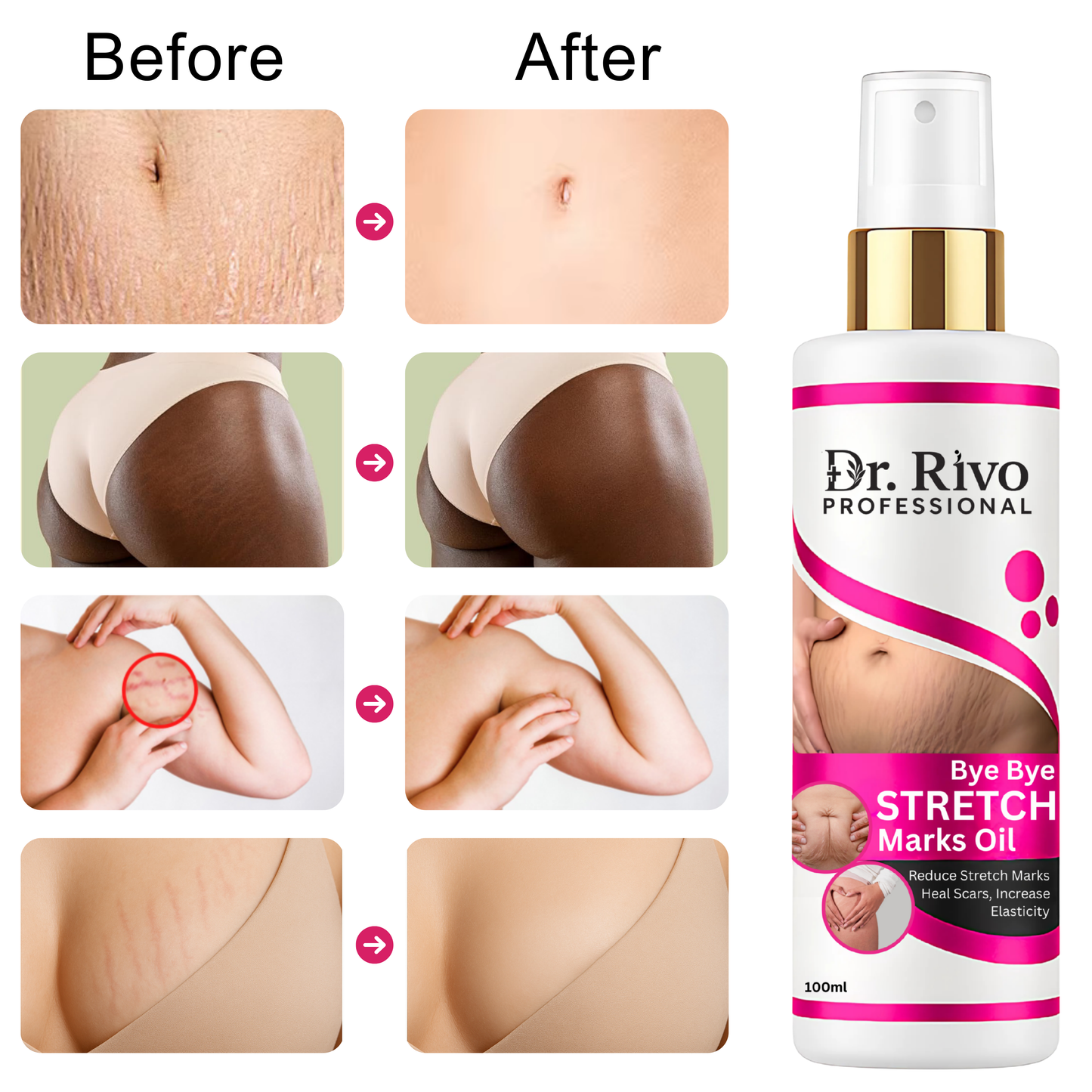 Dr.Rivo Professional present Repair Stretch Marks Removal-Natural Heal Pregnancy Breast,Hip,Legs,Marks oil 100 ml pack of 1