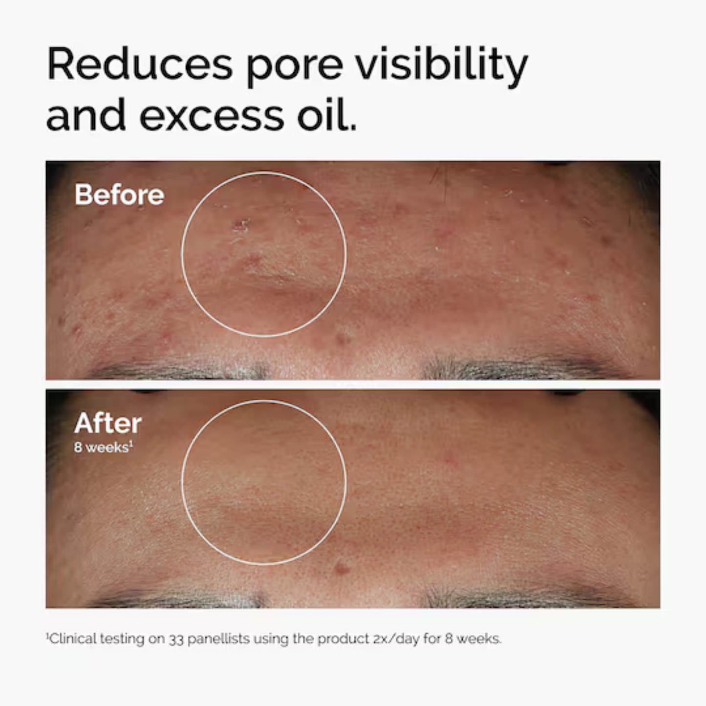 10% Niacinamide + 1% Zinc Face Serum | Powerful Anti-Acne & Glow Formula | Clears Blemishes, Controls Oil | Visible Results