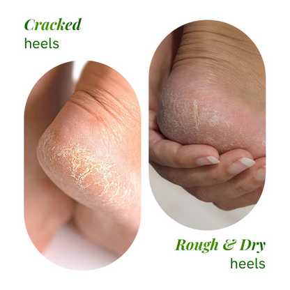 20% Urea Foot Roll-On | For Dry & Cracked Heels  (50 ml, Set of 1)